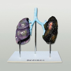 폐의 비교 정상폐와 흡연폐