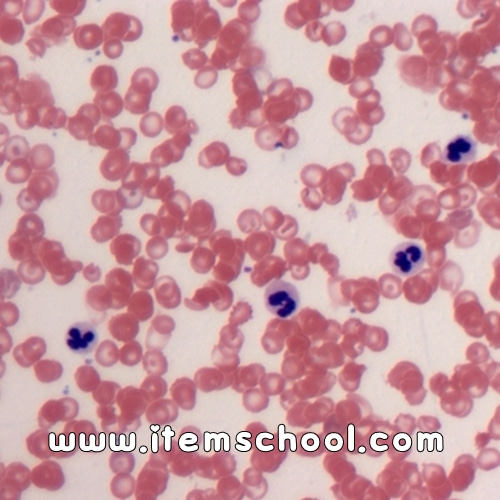 겸형적혈구 슬라이드표본