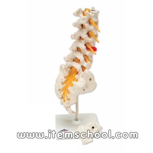 디스크요추 Lumbar Spinal Column with Dorso-Lateral Prolapsed Intervertebral Disc A76/5 [1000150]